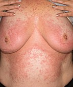 Allergic dermatitis from shower gel
