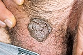 Seborrhoeic keratosis on scrotum