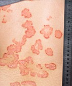 Psoriasis on the back during treatment