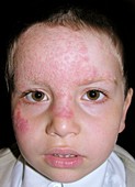 Tinea fungal infection on the face