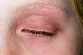 Eczema around the eye