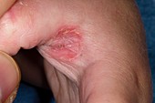 Eczema secondary to thumb sucking