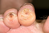 Callus formation on claw toes