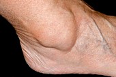 Ganglion over the ankle