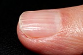 Ridged fingernail in psoriasis