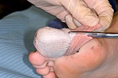 Ingrowing toenail after surgery