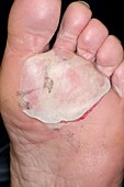 Blister under the foot