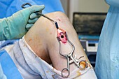 Knee ligament reconstruction surgery