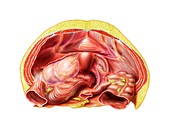 Ovarian cyst in abdomen,artwork