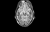Brain injury,MRI scan