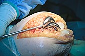 Knee replacement surgery,obese patient