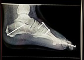Pinned foot bones after surgery,X-ray