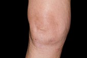 Effusion of the knee after surgery