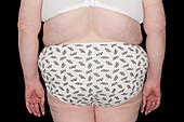 Female obesity after surgery
