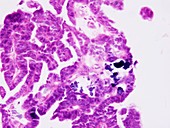 Ovarian cancer,light micrograph