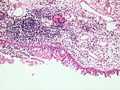 Throat cancer,light micrograph