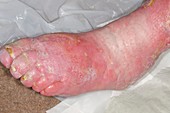 Infected leg ulcer