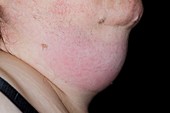 Cellulitis of the neck