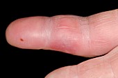 Cellulitis of the finger