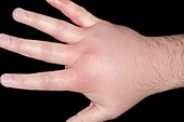 Cellulitis of the hand