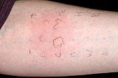 Skin prick allergy test
