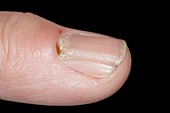 Ganglion overlying the fingernail