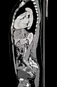 Melanoma liver cancer,CT scan