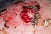 Squamous skin cancer on the scalp