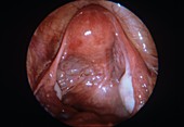 Healthy uterus,endoscope view