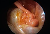 Fallopian fimbriae,endoscope view