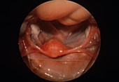 Shrunken womb,endoscope view
