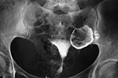 Ectopic pregnancy,X-ray
