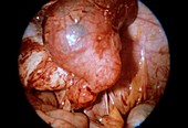 Ectopic pregnancy,endoscope view
