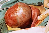Ovarian cyst surgical removal