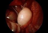 Polycystic ovary,endoscope view
