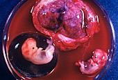 Twin foetuses,8 weeks old