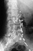 Hodgkin's disease tumour,X-ray