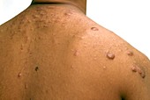 Cystic acne on the shoulders