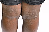 Eczema behind the knees