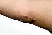 Surgical scar on golfer's elbow