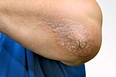 Psoriasis on the elbow