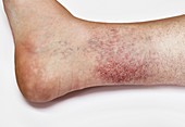 Enlarged blood vessels on the skin