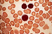 Chronic lymphocytic leukaemia,micrograph