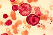 Infectious mononucleosis,micrograph