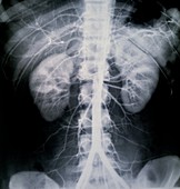 Atherosclerosis,X-ray