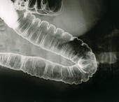 Healthy large intestine,X-ray