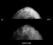 Targeted breast surgery,mammogram