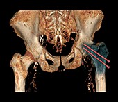 Hip fracture reduction,3D CT scan
