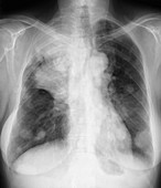 Secondary lung cancer,X-ray