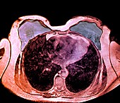Double mastectomy breast implants,MRI